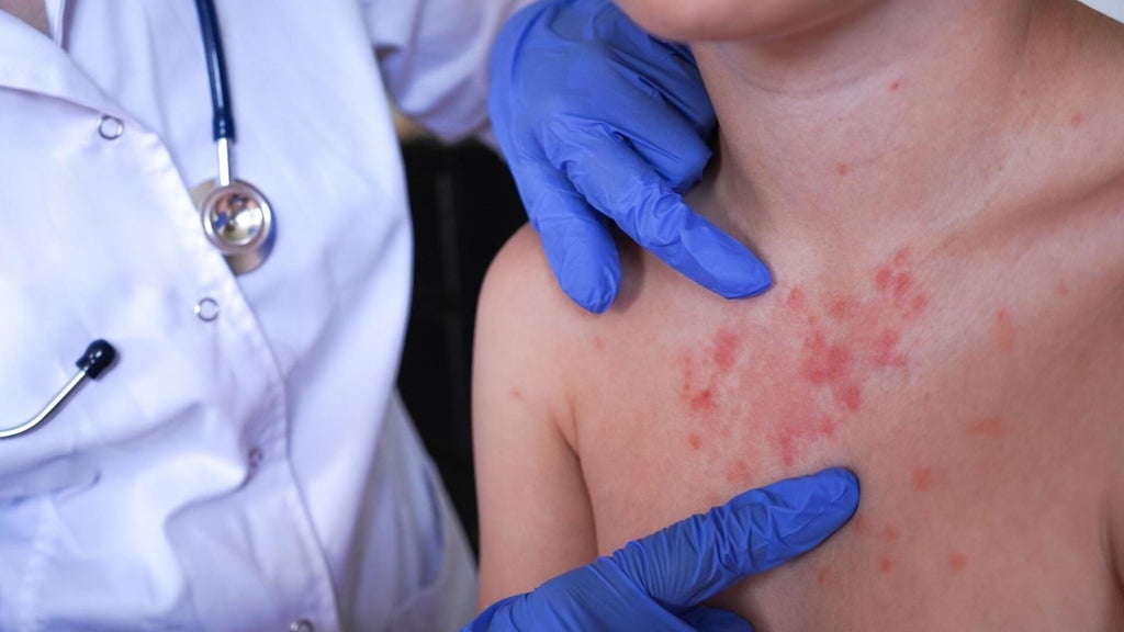 Minnesota's 80 measles cases this year are the most since 1990, health officials say — Prior Lake Health news